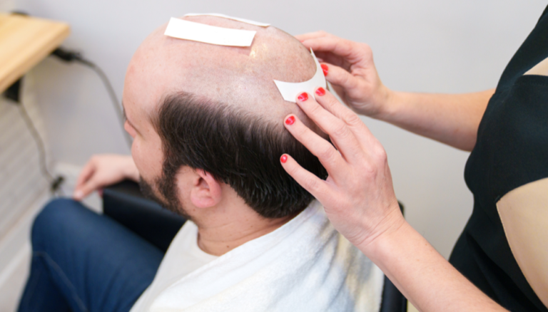 Kensington Clinic: London's Top Choice for PRP Hair Treatment